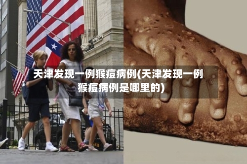 天津发现一例猴痘病例(天津发现一例猴痘病例是哪里的)